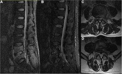 A comprehensive clinical analysis of the use of percutaneous endoscopic debridement for the treatment of early lumbar epidural abscesses